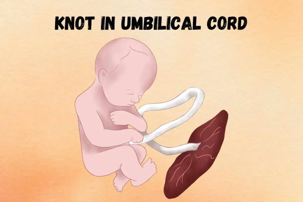 true-knot-in-umbilical-cord-superstition-spiritual-meaning